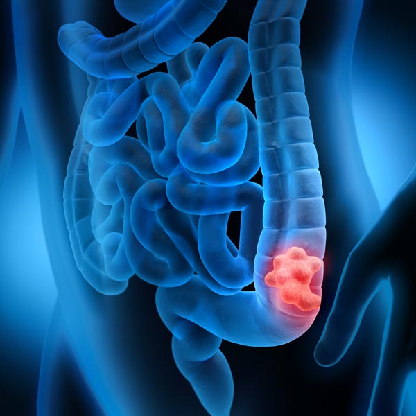 colon cancer