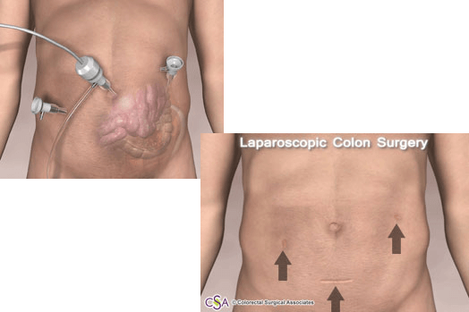 laparoscopic surgery